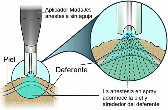 vasectomia sin dolor coruña